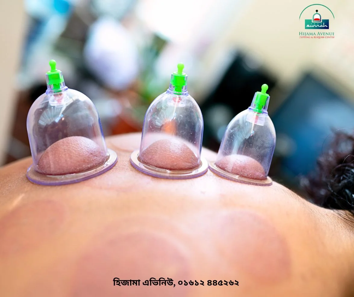What is Hijama? Why Should You Get Hijama?